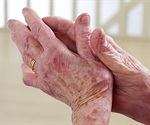 3D biomaterial helps implanted stem cells stick around to reverse arthritis
