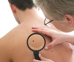 Key blood marker could offer the most effective treatment for melanoma