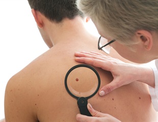Researchers discover molecular mechanism that explains why moles become melanomas