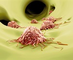 Peptide-enhanced, biological cancer drug may help treat breast cancer metastasis to bone