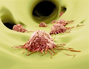 Blocking Necroptosis Could Lead to the Inhibition of Cancer Metastasis