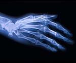 Study identifies previously unknown cell types that drive the onset of osteoarthritis
