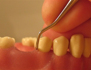 Double-stranded RNA provoke bone loss during periodontitis