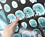 New radiotracer provides a quantitative measure of disease progression after stroke