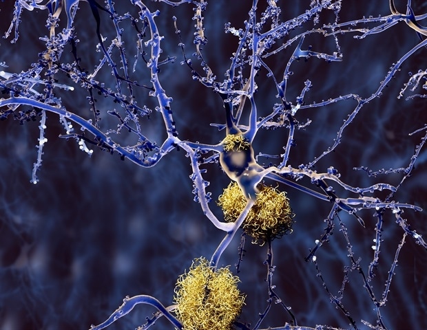 Scientists Pioneer mRNA Approach to Target Alzheimer's Protein