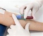 Gene-based blood test may predict treatment success in people with metastatic melanoma