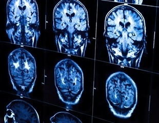 Brain scans link signs of cellular aging to symptoms of Alzheimer’s