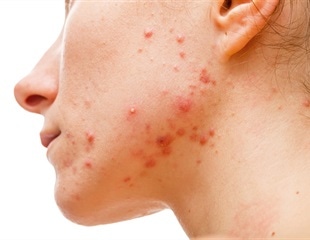 Nonpathogenic strain of C. acnes improves skin's resistance against infection-causing bacteria
