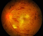 Lipe Gene Plays Pivotal Role in Retinal Health, Study Finds