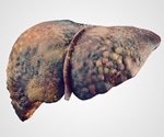 Small Vesicles Originating From Intestinal Bacteria Have an Adverse Effect on the Liver