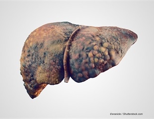 Small Vesicles Originating From Intestinal Bacteria Have an Adverse Effect on the Liver