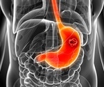 New study breaks down the risk of stomach cancer in non-white Americans