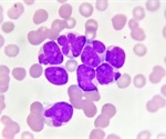 Combination regimen improves overall survival in acute myeloid leukemia patients