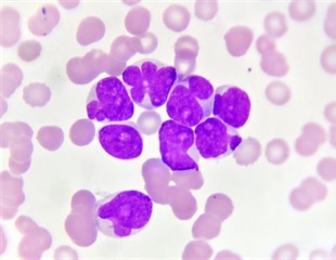 CSHL researchers spotlight the role of a previously little-known protein in leukemia