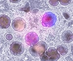 Researchers identify key gene essential for leukemia stem cells' survival