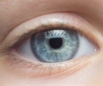 Biomarker for diagnosis of neurodegenerative diseases identified in the eye