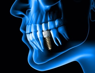 Rethinking Antibiotics: Dental Professionals Embrace New Alternatives For Standard Dental Procedures