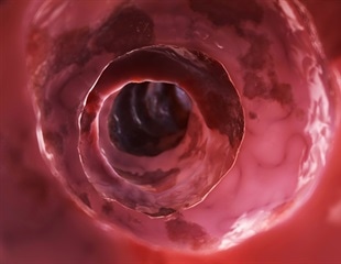 Machine learning algorithm helps differentiate benign and premalignant colorectal polyps