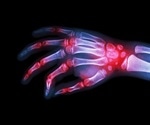 New breakthrough in understanding the role of high-risk immune genes in rheumatoid arthritis
