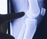 Novel molecule shown to have potential therapeutic effects for arthritis
