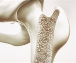 Functional bone imaging technique reveals the progression of knee osteoarthritis