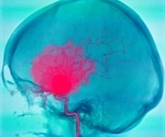New method can enable early detection and treatment of cerebral aneurysms