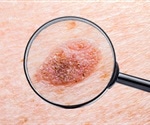 Scientists identify new biomarkers in the blood of patients with malignant melanoma