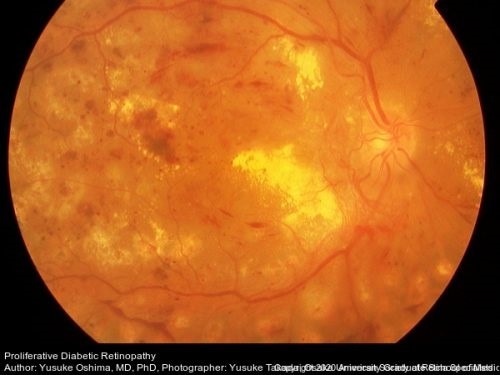 Researchers discover genetic factors underlying diabetic retinopathy