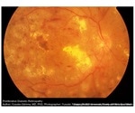 Researchers discover genetic factors underlying diabetic retinopathy