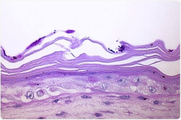 Malassezia globosa—Antidandruff effect in colonization of Labskin with Malassezia.