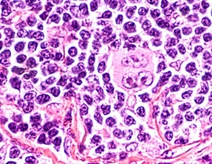 Study reveals significant neighborhood preferences of tumor cells in Hodgkin lymphoma