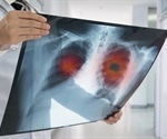 Potential biomarker for lung cancer prognosis revealed