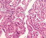 Circular RNA profiles could serve as a biomarker of ovarian cancer