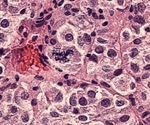 Scientists Double Understanding Of Genetic Risk Of Melanoma