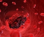 Novel tool distinguishes the cause of different types of blood clots