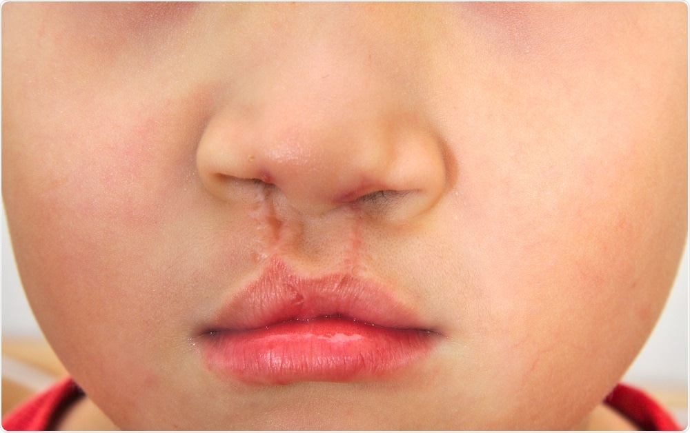 Child with Cleft Lip