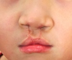 Children Born With A Cleft Lip Unlikely To Be Genetically Inclined To Do Poorly At School