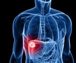 Study shows senotherapy blunts the progression of liver tumors