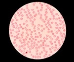 Small Red Blood Cells Could Indicate Cancer