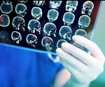 Diagnosing Brain Tumors With A Blood Test