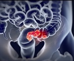 Rapid genomic profiling of colon cancers can improve therapy
