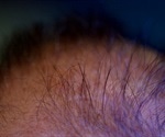 Study pinpoints the miRNA that promotes hair follicle growth