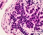 Enhancing Breast Cancer Therapy through Killing ‘Sleeper Cells’