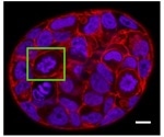 Study shows how tumor cells gain enhanced ability to deal with crowded tumor environment