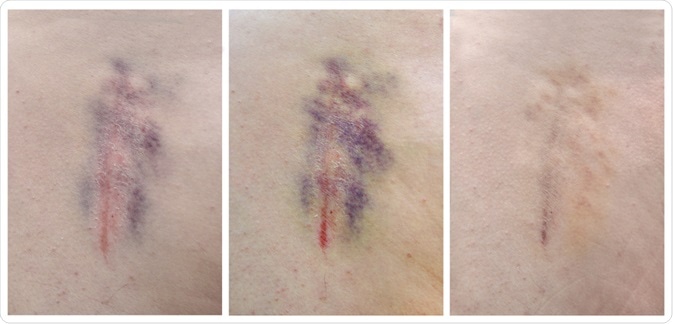 Color Change on Bruise