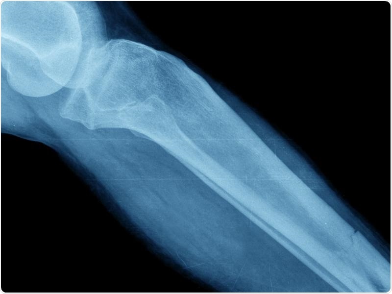 Loss of enzymatic processes can increase risk of bone fracture