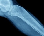 Loss of enzymatic processes can increase the risk of bone fracture