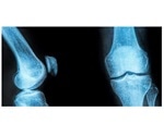 Study identifies genes involved in people with osteoarthritis