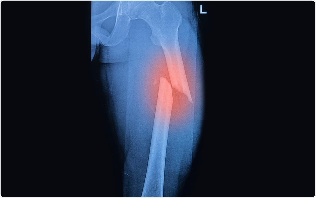 Mesenchymal stem cells with enhanced fracture healing abilities identified