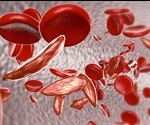 Study explores factors that influence the disparities in sickle cell disease